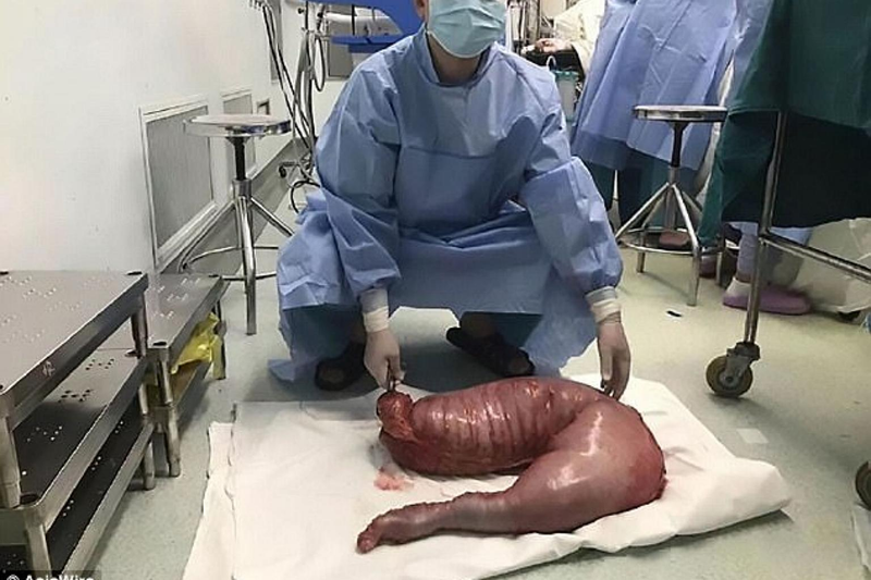 El megacolon de Hai. Imagen: AsiaWire